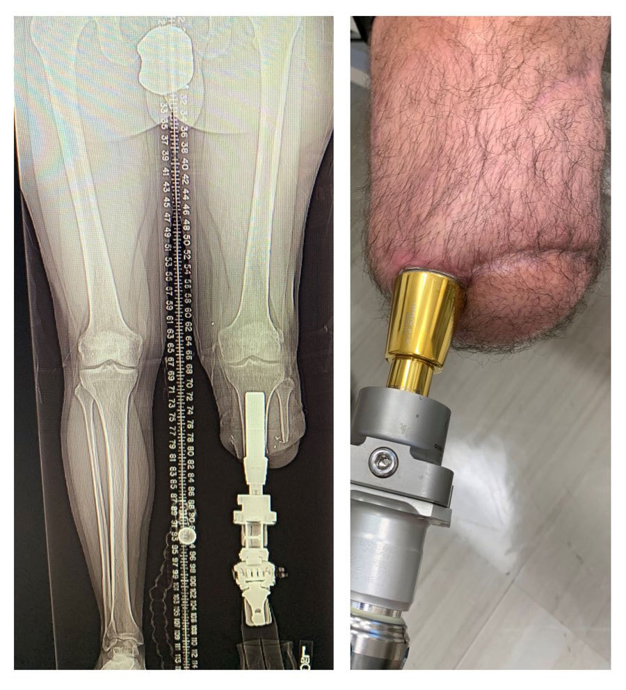 An x-ray showing a person's legs - one with an implant via osseointegration in the right leg. A photograph of a person's leg with the implant. 